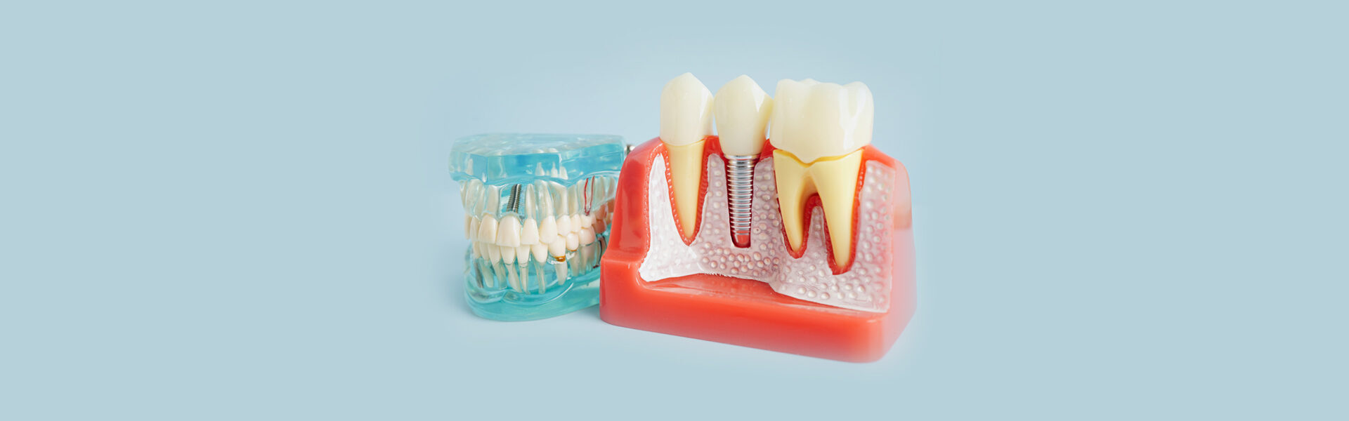 Dental Implants in Arlington, TX