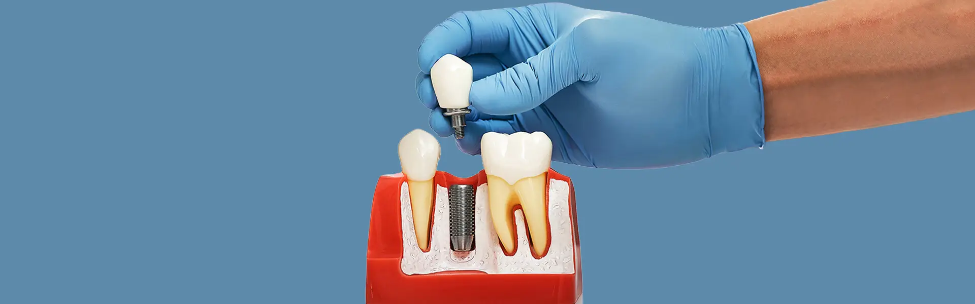 Why Is Oral Hygiene Important After Dental Implants?