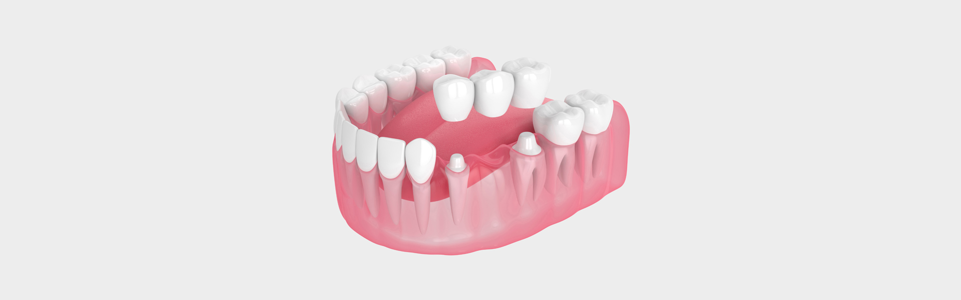 Missing Teeth? How a Dental Bridge Can Help
